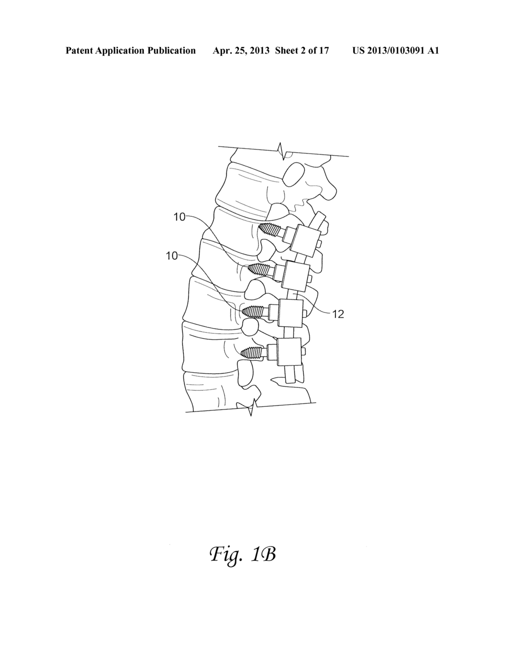 SPINAL FUSION INSTRUMENTATION AND SYSTEMS AND METHODS THEREOF - diagram, schematic, and image 03