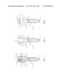 SPINAL IMPLANT SYSTEM AND METHOD diagram and image