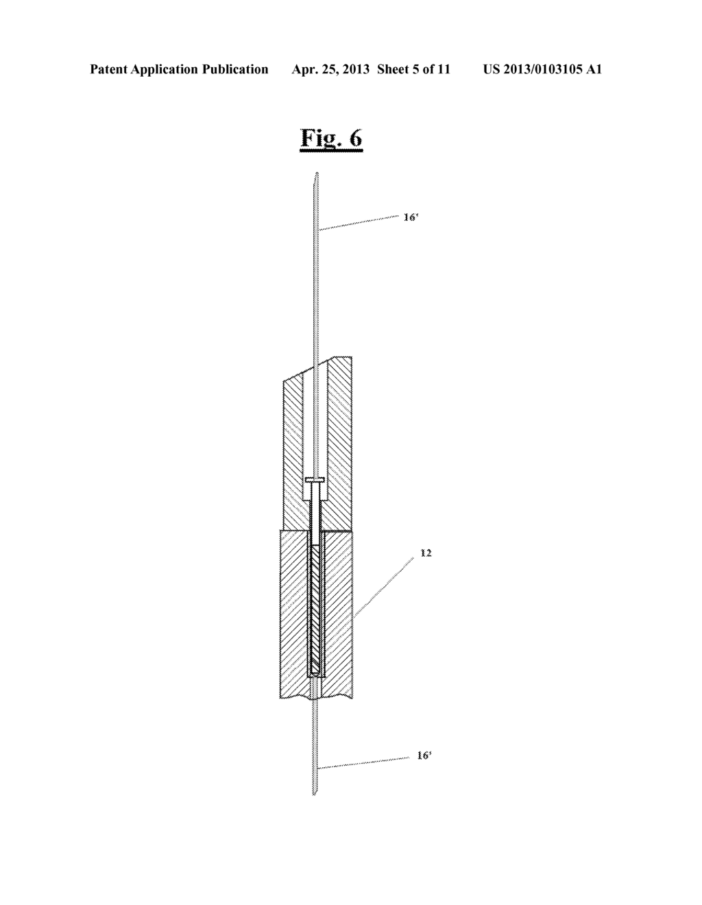 DEVICE FOR FACILITATING THE APPLICATION OF A FIXING PLATE TO THE RELATIVE     SCREW FOR THE MINIMALLY INVASIVE STABILIZATION OF PERTROCHANTERIC FEMORAL     FRACTURES WITH SLIDING SCREW-PLATE SYSTEMS - diagram, schematic, and image 06