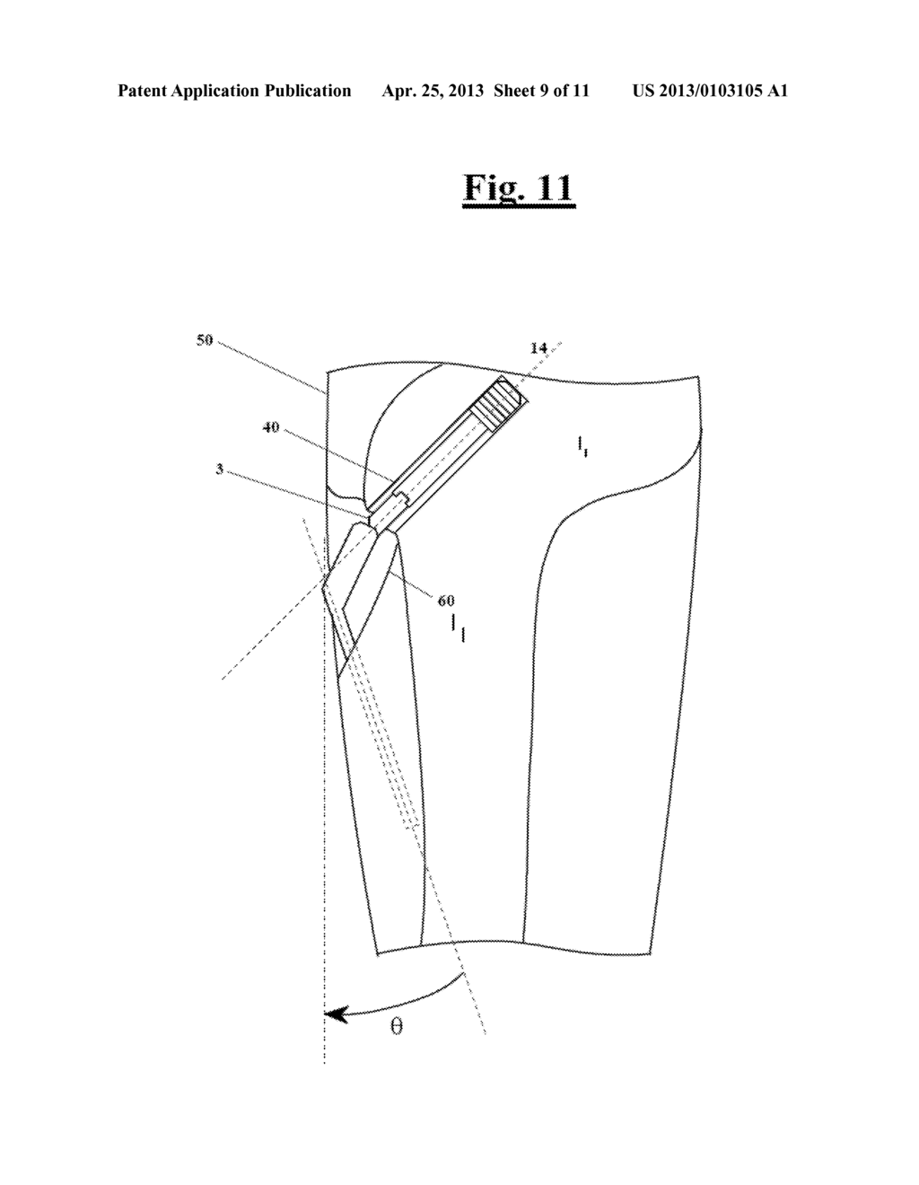 DEVICE FOR FACILITATING THE APPLICATION OF A FIXING PLATE TO THE RELATIVE     SCREW FOR THE MINIMALLY INVASIVE STABILIZATION OF PERTROCHANTERIC FEMORAL     FRACTURES WITH SLIDING SCREW-PLATE SYSTEMS - diagram, schematic, and image 10