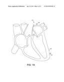 Leadless Cardiac Pacemaker Triggered by Conductive Communication diagram and image