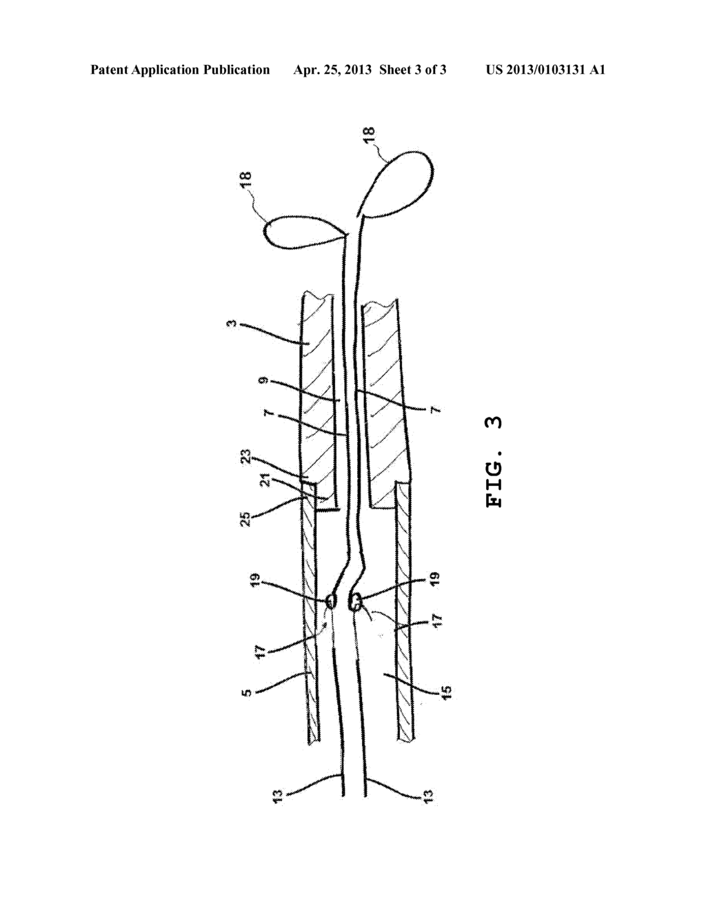 IMPLANT DELIVERY DEVICE ADAPTED TO BE ATTACHED TO OR INTERCONNECTED WITH A     CATHETER, CATHETER AND METHOD - diagram, schematic, and image 04