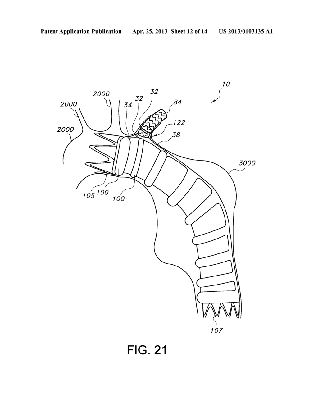 FENESTRATED INFLATABLE GRAFT - diagram, schematic, and image 13