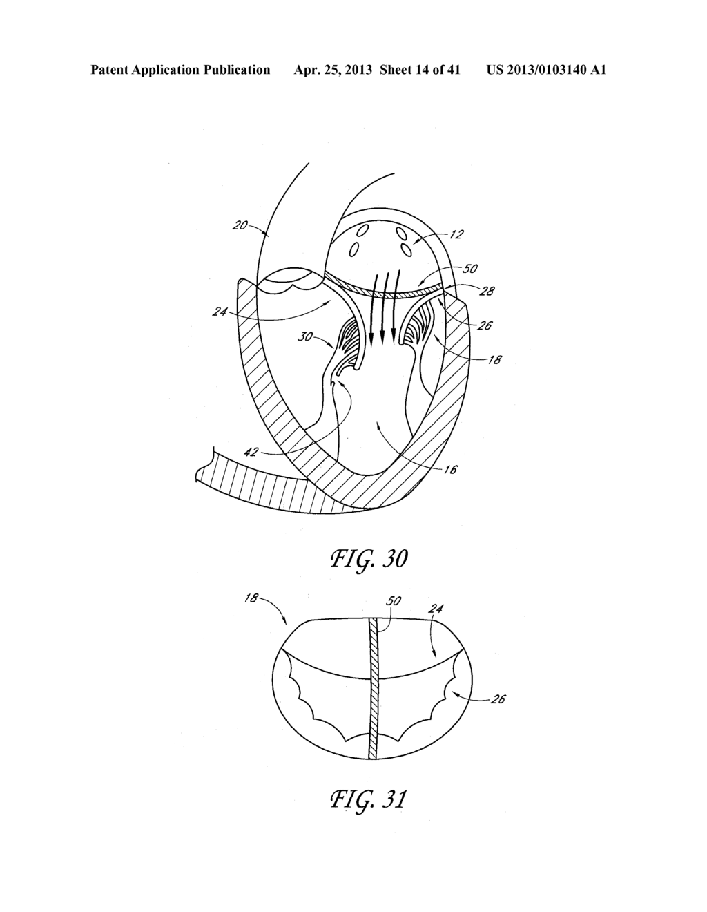 PERCUTANEOUS TRANSVALVULAR INTRAANNULAR BAND FOR MITRAL VALVE REPAIR - diagram, schematic, and image 15