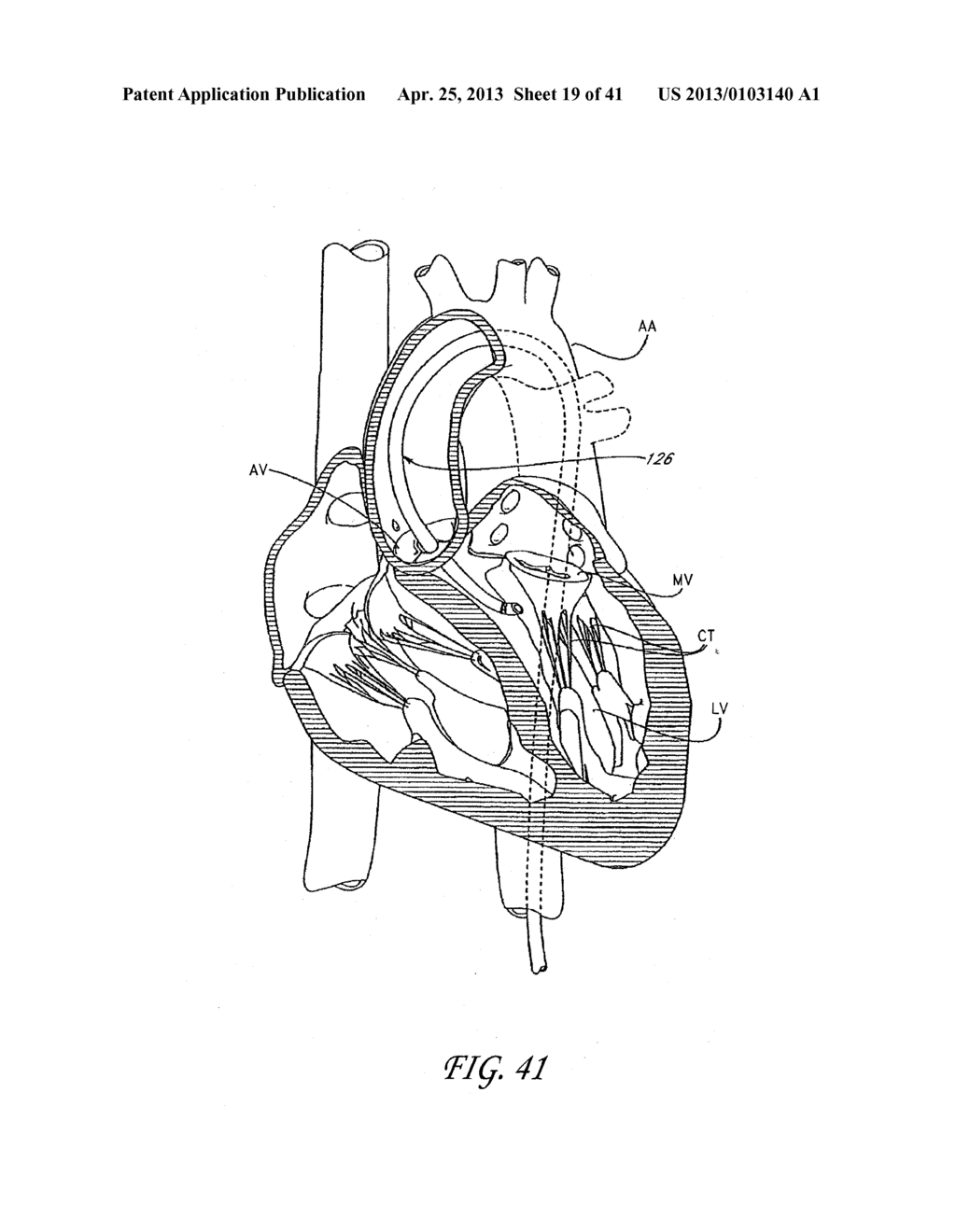 PERCUTANEOUS TRANSVALVULAR INTRAANNULAR BAND FOR MITRAL VALVE REPAIR - diagram, schematic, and image 20