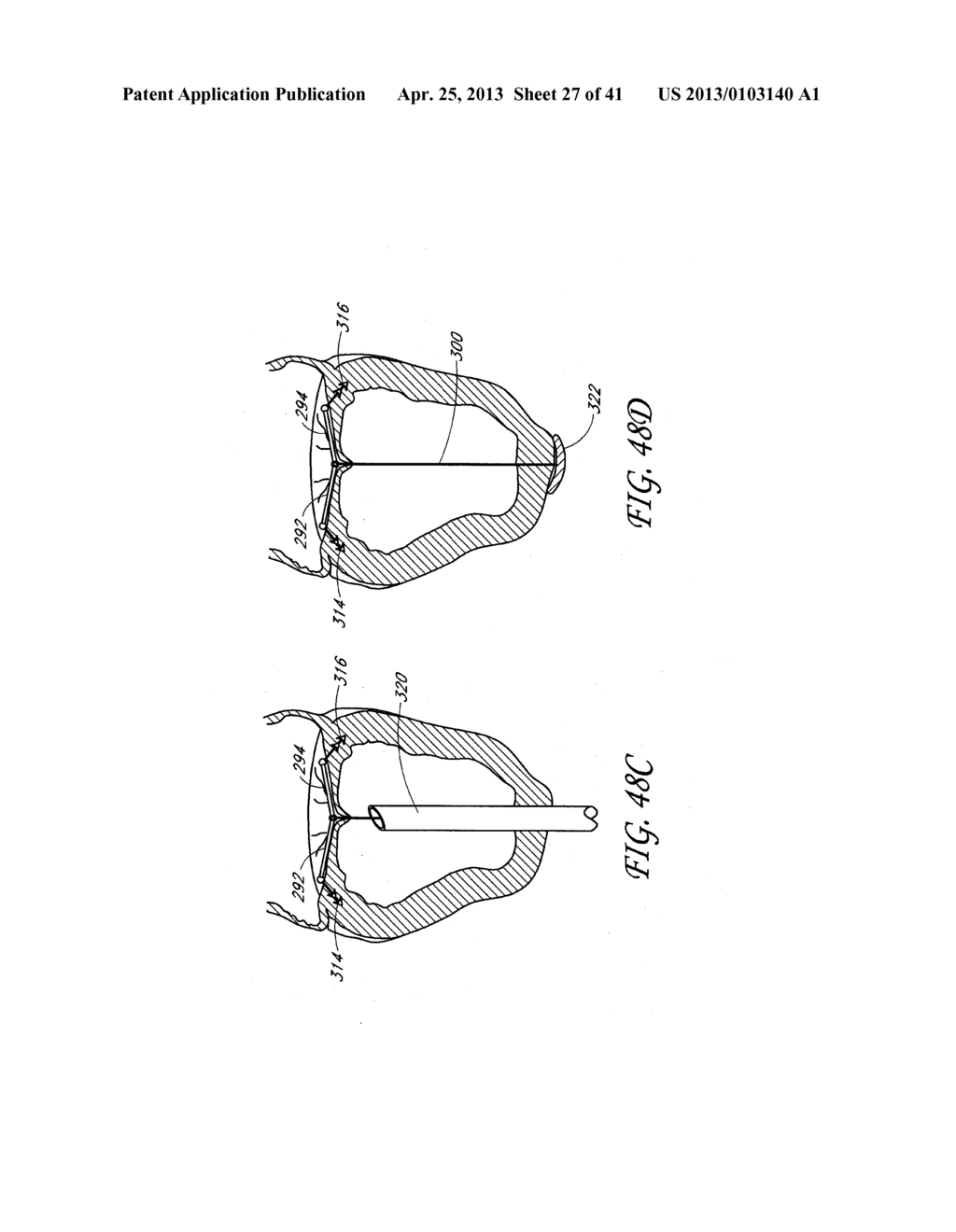 PERCUTANEOUS TRANSVALVULAR INTRAANNULAR BAND FOR MITRAL VALVE REPAIR - diagram, schematic, and image 28