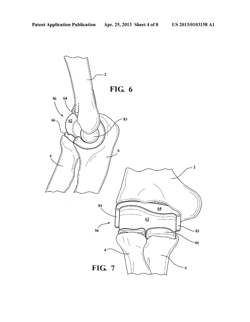 IMPLANTABLE ELBOW JOINT ASSEMBLY WITH SPHERICAL INTER-SUPPORT - diagram, schematic, and image 05