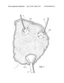 ORTHOTOPIC ARTIFICIAL BLADDER PROSTHESIS diagram and image