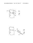 Reshapable Device for Fixation at a Dental Site diagram and image