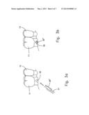 Reshapable Device for Fixation at a Dental Site diagram and image