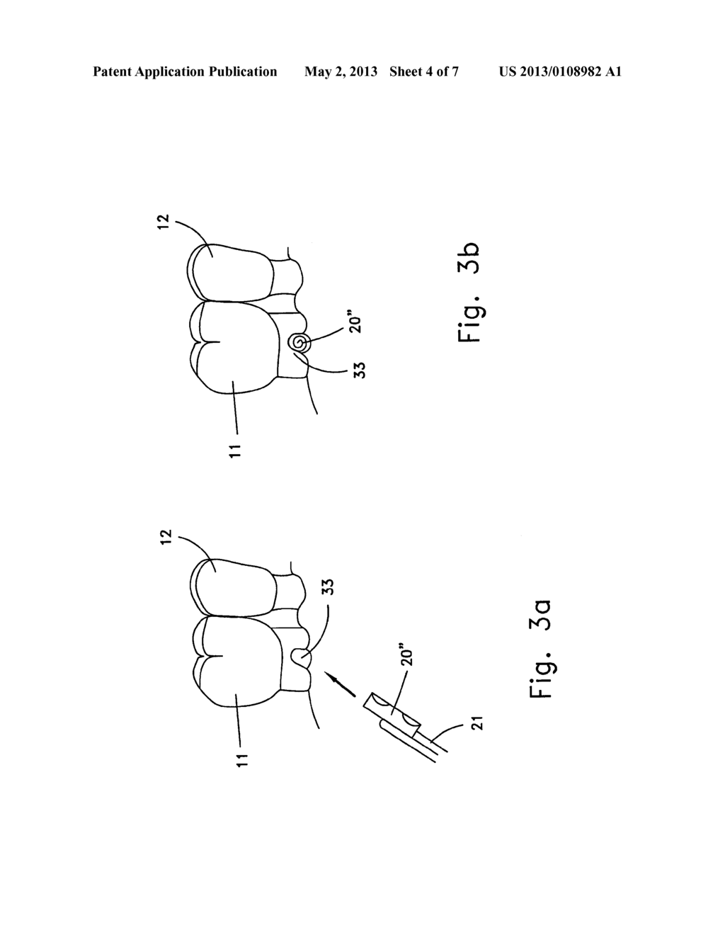 Reshapable Device for Fixation at a Dental Site - diagram, schematic, and image 05