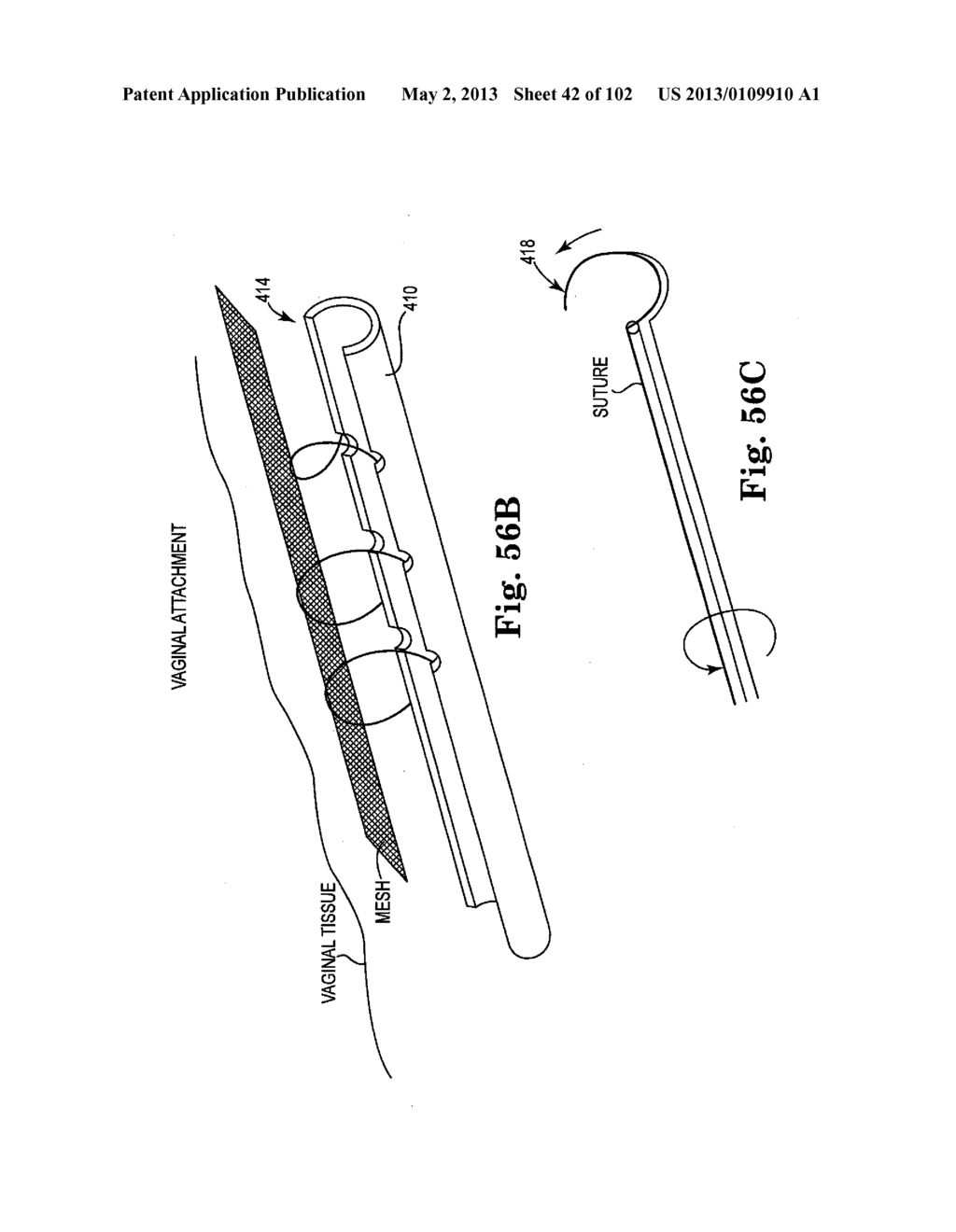 SYSTEMS, IMPLANTS, TOOLS, AND METHODS FOR TREATMENTS OF PELVIC CONDITIONS - diagram, schematic, and image 43