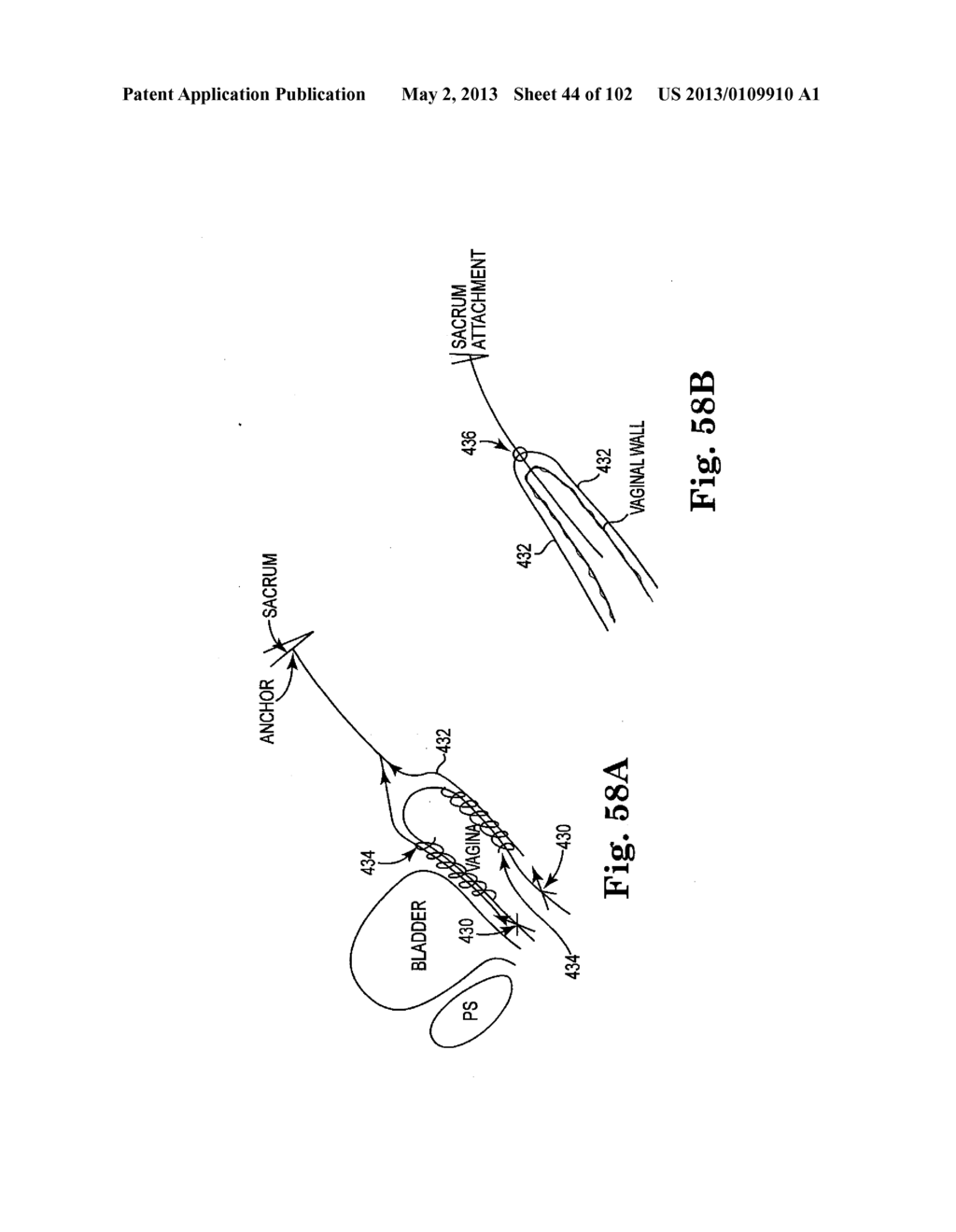 SYSTEMS, IMPLANTS, TOOLS, AND METHODS FOR TREATMENTS OF PELVIC CONDITIONS - diagram, schematic, and image 45