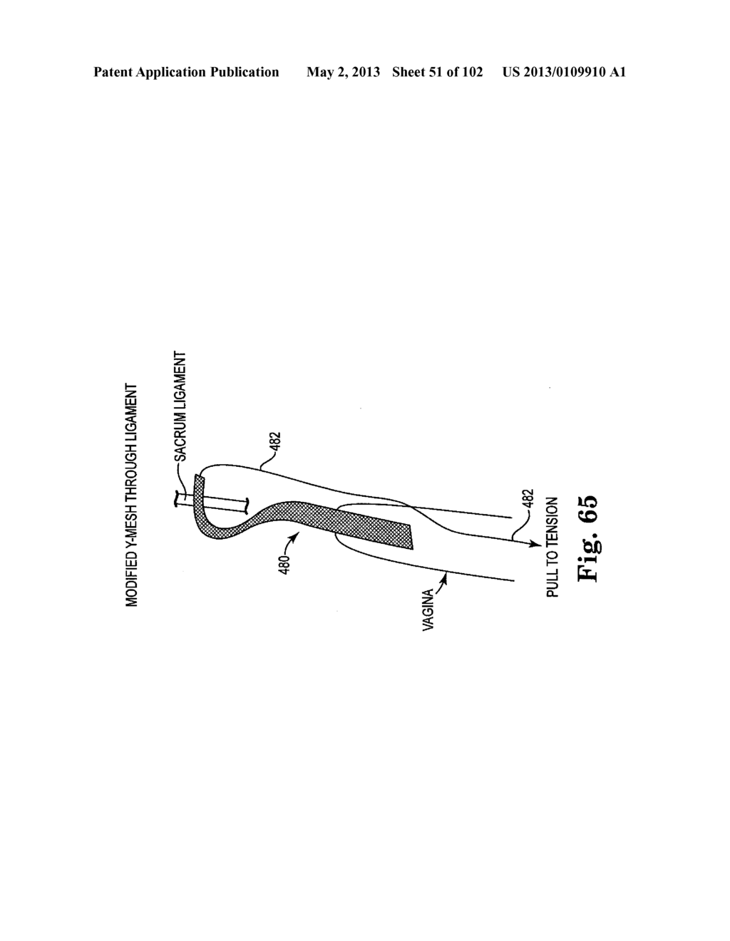 SYSTEMS, IMPLANTS, TOOLS, AND METHODS FOR TREATMENTS OF PELVIC CONDITIONS - diagram, schematic, and image 52