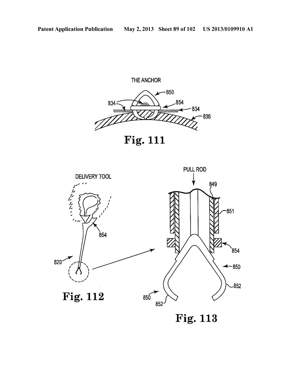 SYSTEMS, IMPLANTS, TOOLS, AND METHODS FOR TREATMENTS OF PELVIC CONDITIONS - diagram, schematic, and image 90