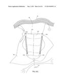 APPARATUS AND METHOD FOR INTRA-ABDOMINALLY MOVING A FIRST INTERNAL ORGAN     TO A POSITION AWAY FROM A SECOND INTERNAL ORGAN AND THEN HOLDING THE     FIRST INTERNAL ORGAN IN THE POSITION WITHOUT MANUAL INPUT diagram and image