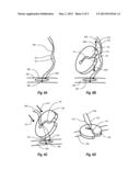 SUTURE CLIP diagram and image