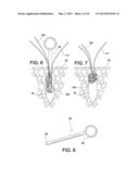 SOFT SUTURE-BASED ANCHORS diagram and image