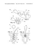 SOFT SUTURE-BASED ANCHORS diagram and image