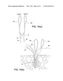 SOFT SUTURE-BASED ANCHORS diagram and image