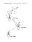 SOFT SUTURE-BASED ANCHORS diagram and image