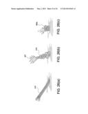 SOFT SUTURE-BASED ANCHORS diagram and image