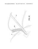 SOFT SUTURE-BASED ANCHORS diagram and image