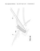 SOFT SUTURE-BASED ANCHORS diagram and image