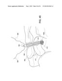 SOFT SUTURE-BASED ANCHORS diagram and image