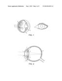 INTRAOCULAR LENS diagram and image