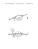 INTRAOCULAR LENS diagram and image