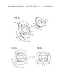 JOINT IMPLANT diagram and image