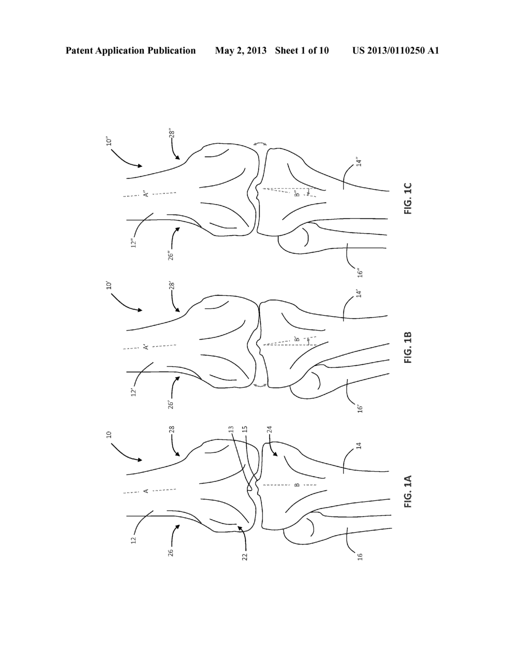 METHOD OF ESTIMATING SOFT TISSUE BALANCE FOR KNEE ARTHROPLASTY - diagram, schematic, and image 02