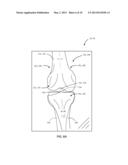 METHOD OF ESTIMATING SOFT TISSUE BALANCE FOR KNEE ARTHROPLASTY diagram and image