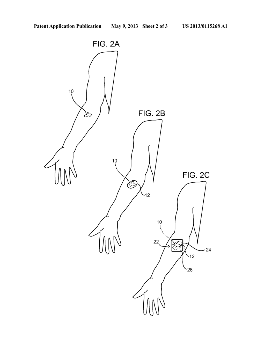 Methods of Administering a Dermatological Agent to a Subject - diagram, schematic, and image 03