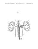 APPARATUS AND METHOD FOR RADIATION TREATMENT OF A DESIRED AREA IN THE     RENAL VASCULAR SYSTEM OF A PATIENT diagram and image