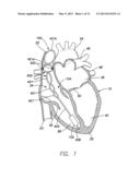 LEADLESS INTRA-CARDIAC MEDICAL DEVICE WITH BUILT-IN TELEMETRY SYSTEM diagram and image