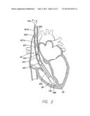 LEADLESS INTRA-CARDIAC MEDICAL DEVICE WITH BUILT-IN TELEMETRY SYSTEM diagram and image