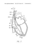 LEADLESS INTRA-CARDIAC MEDICAL DEVICE WITH BUILT-IN TELEMETRY SYSTEM diagram and image