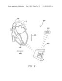 LEADLESS INTRA-CARDIAC MEDICAL DEVICE WITH BUILT-IN TELEMETRY SYSTEM diagram and image