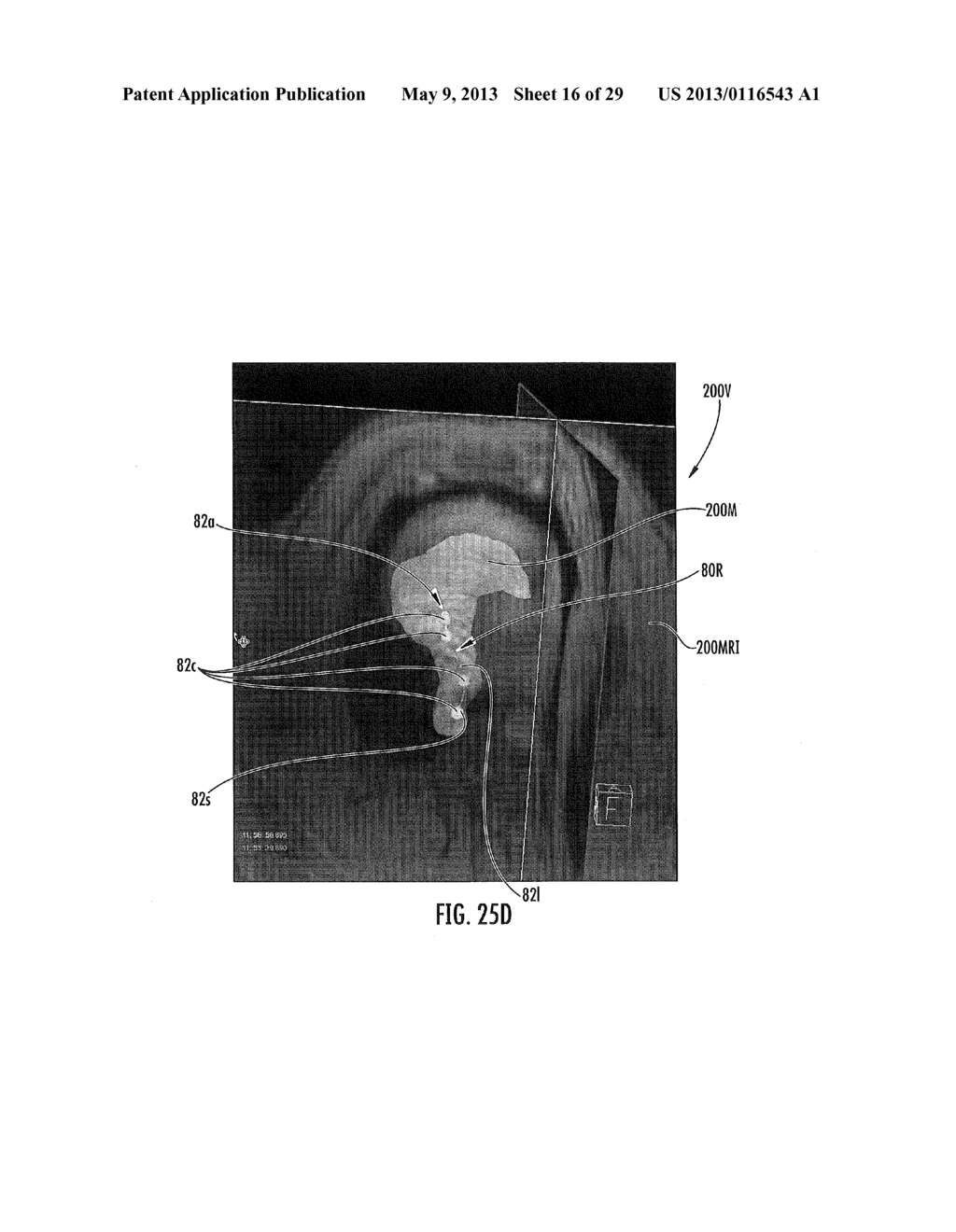 MRI-GUIDED DEVICES AND MRI-GUIDED INTERVENTIONAL SYSTEMS THAT CAN TRACK     AND GENERATE DYNAMIC VISUALIZATIONS OF THE DEVICES IN NEAR REAL TIME - diagram, schematic, and image 17