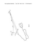 Endoscopic Vessel Sealer and Divider for Large Tissue Structures diagram and image