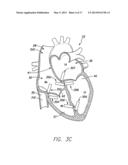 SINGLE CHAMBER LEADLESS INTRA-CARDIAC MEDICAL DEVICE WITH DUAL-CHAMBER     FUNCTIONALITY diagram and image