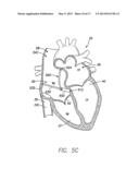 SINGLE CHAMBER LEADLESS INTRA-CARDIAC MEDICAL DEVICE WITH DUAL-CHAMBER     FUNCTIONALITY diagram and image