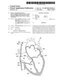 SINGLE-CHAMBER LEADLESS INTRA-CARDIAC MEDICAL DEVICE WITH DUAL-CHAMBER     FUNCTIONALITY AND SHAPED STABILIZATION INTRA-CARDIAC EXTENSION diagram and image