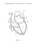 SINGLE-CHAMBER LEADLESS INTRA-CARDIAC MEDICAL DEVICE WITH DUAL-CHAMBER     FUNCTIONALITY AND SHAPED STABILIZATION INTRA-CARDIAC EXTENSION diagram and image