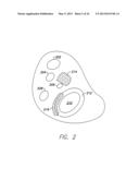 SINGLE-CHAMBER LEADLESS INTRA-CARDIAC MEDICAL DEVICE WITH DUAL-CHAMBER     FUNCTIONALITY AND SHAPED STABILIZATION INTRA-CARDIAC EXTENSION diagram and image