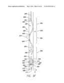 SINGLE-CHAMBER LEADLESS INTRA-CARDIAC MEDICAL DEVICE WITH DUAL-CHAMBER     FUNCTIONALITY AND SHAPED STABILIZATION INTRA-CARDIAC EXTENSION diagram and image