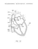 SINGLE-CHAMBER LEADLESS INTRA-CARDIAC MEDICAL DEVICE WITH DUAL-CHAMBER     FUNCTIONALITY AND SHAPED STABILIZATION INTRA-CARDIAC EXTENSION diagram and image