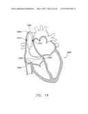 SINGLE-CHAMBER LEADLESS INTRA-CARDIAC MEDICAL DEVICE WITH DUAL-CHAMBER     FUNCTIONALITY AND SHAPED STABILIZATION INTRA-CARDIAC EXTENSION diagram and image